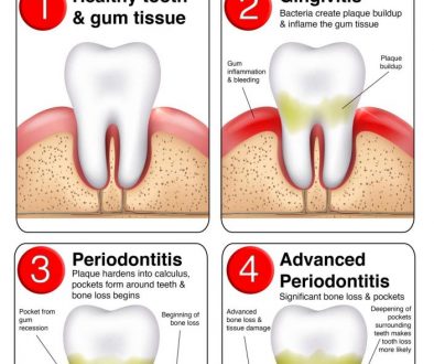 Waupaca Dentist Periodontal Disease graphic