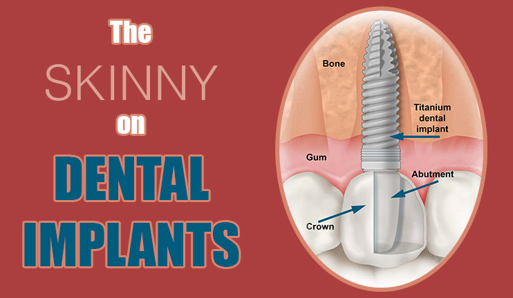 Waupaca Dentist Dental Implants graphic