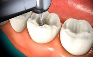 root-canal-300x186 Root Canal Therapy Waupaca Dentist