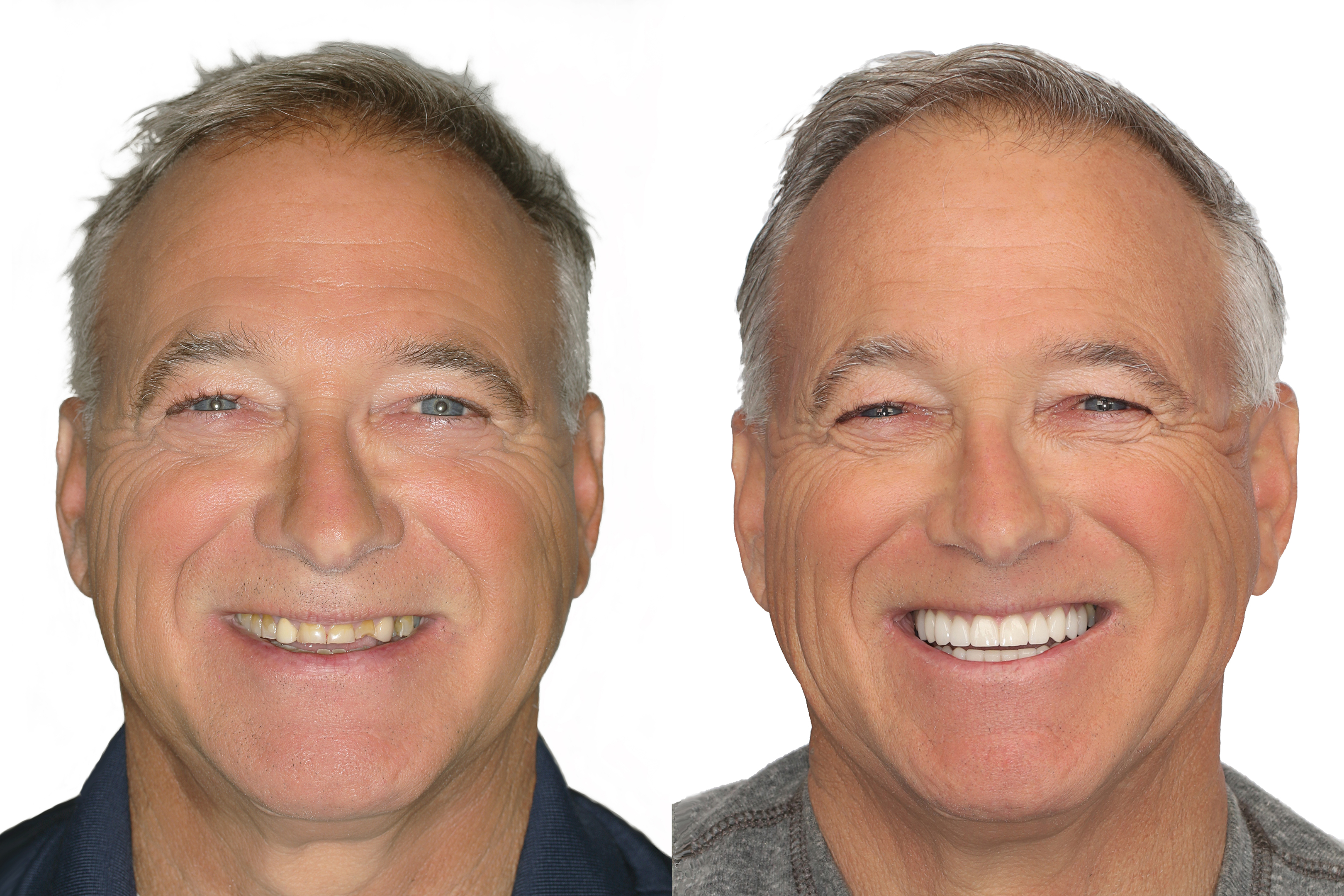 Restoring Your Smile to Health