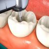Rootless Fears: Root Canal Therapy Gets a Bad Rap