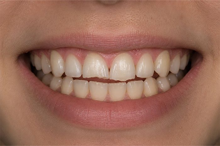 Cosmetic-Composite-Bonding-Path-before Cosmetic-Composite-Bonding-Path-before