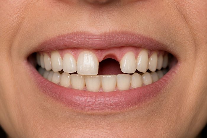 Close-up of a smile with a missing front tooth