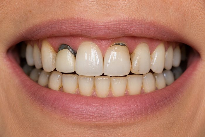 Close-up of a smile showing worn teeth and old metal fillings
