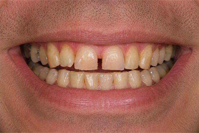 Smile-Makeover-before Smile-Makeover-before
