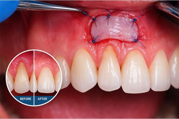 Gum-recession-treatment